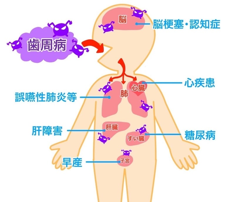 歯周病が与える全身へ影響