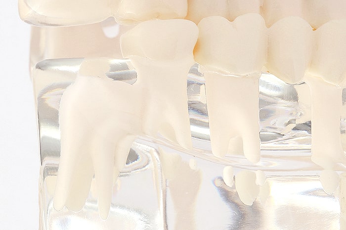 親知らずの抜歯が怖くて決断できない方へ